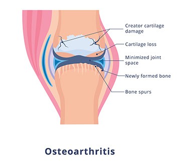 Osteoarthritis of the Knee Meriden