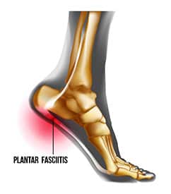 Plantar Fasciitis Meriden