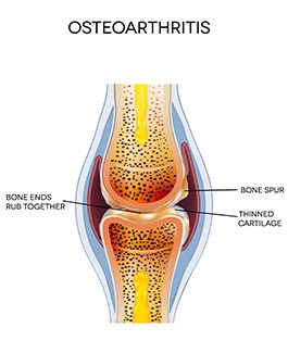 Symptoms of Osteoarthritis Hartford