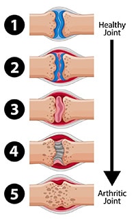 Treatments for Osteoarthritis Meriden