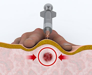 Trigger Points Injections New Haven