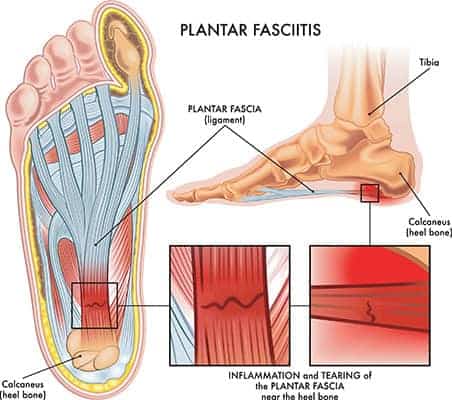What is Plantar Fasciitis? Hartford